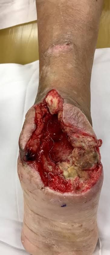 Bacterial infection of the heel