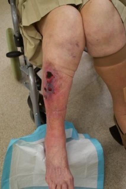 Bacterial infection of the leg