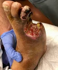 Bacterial infection of the toes